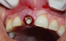 Dental Implant