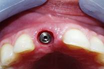 Dental Implant
