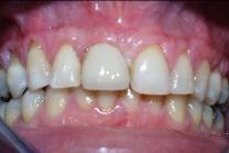 Dental Implant