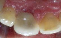 Dental Implant