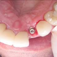 Dental Implant