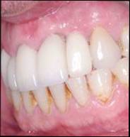 Dental Implant