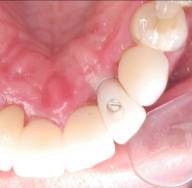 Dental Implant
