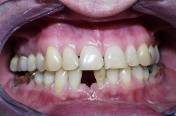 Dental Implant