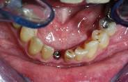 Dental Implant