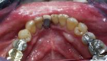 Dental Implant