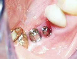 Dental Implant