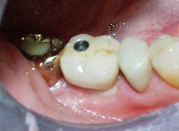 Dental Implant