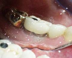 Dental Implant