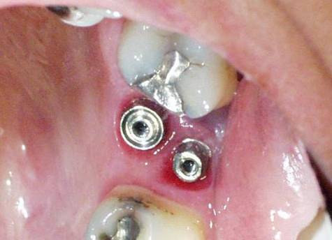 Dental Implant