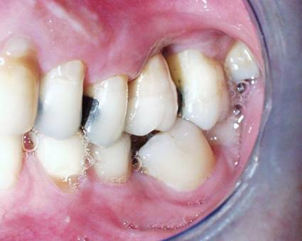 Dental Implant