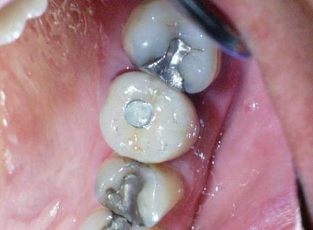 Dental Implant