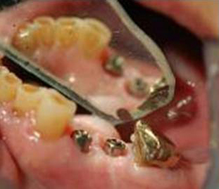 Dental Implant