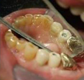 Dental Implant
