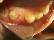 Dental Implant