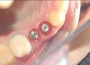 Dental Implant