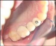 Dental Implant