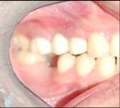 Dental Implant