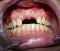 Dental Implant