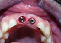 Dental Implant