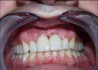 Dental Implant