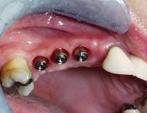 Dental Implant