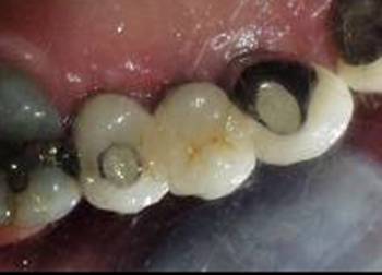 Dental Implant