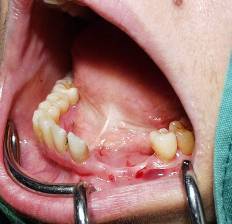Dental Implant