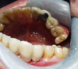 Dental Implant