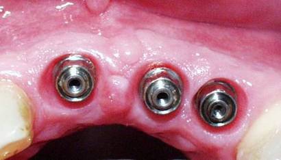 Dental Implant