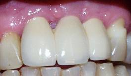 Dental Implant