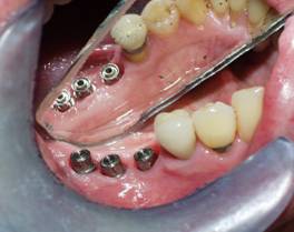 Dental Implant