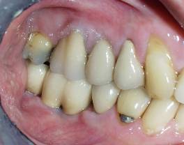 Dental Implant