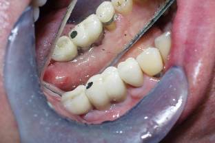 Dental Implant
