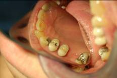 Dental Implant