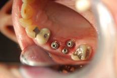 Dental Implant
