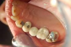 Dental Implant