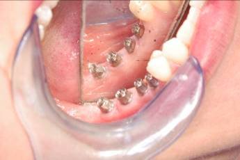 Dental Implant