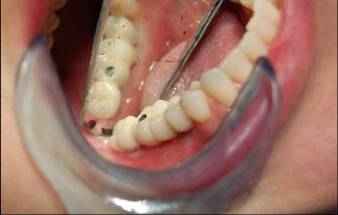 Dental Implant