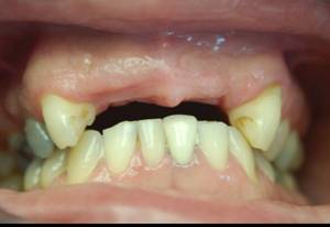 Dental Implant