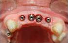 Dental Implant