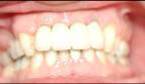 Dental Implant