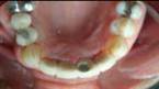 Dental Implant