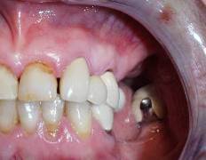 Dental Implant