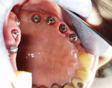 Dental Implant
