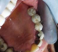 Dental Implant