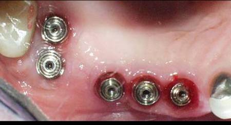 Dental Implant