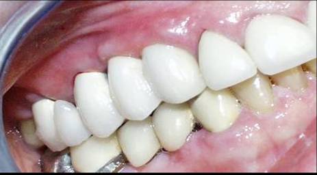 Dental Implant