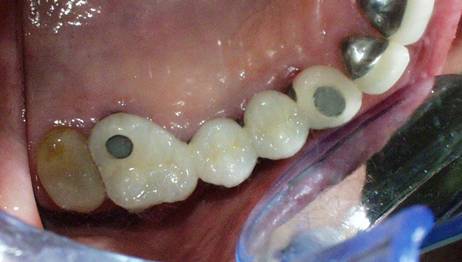 Dental Implant