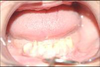Dental Implant